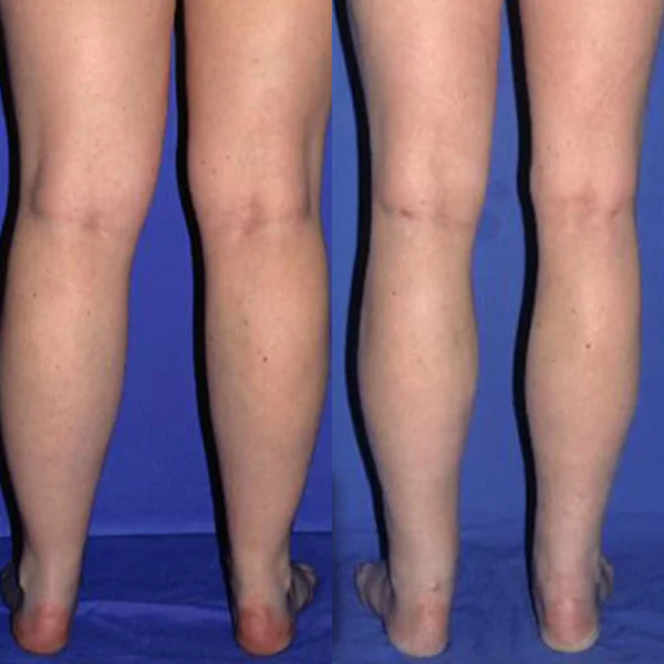 Draen customer photo 2 — individual experience, results not typical